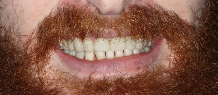 Close-up of restored teeth after treatment at Roots Dental, cosmetic and emergency dentist in Bellingham.