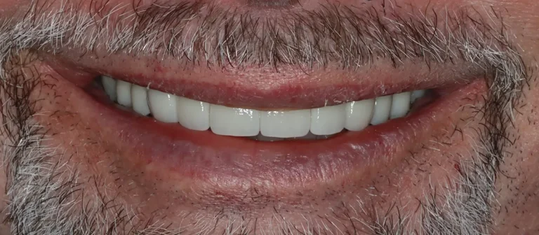 Close-up of restored, natural-looking teeth after cosmetic dental treatment at Roots Dental in Bellingham.