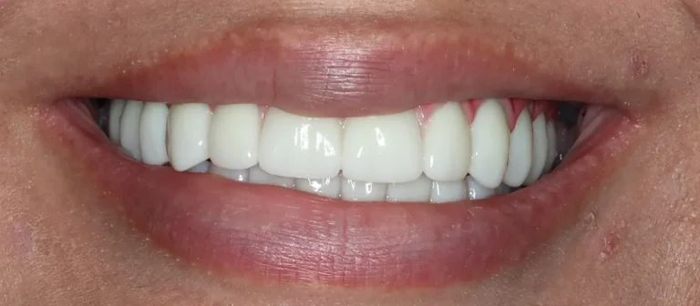 Beautiful smile after full-mouth restoration at Roots Dental in Bellingham.