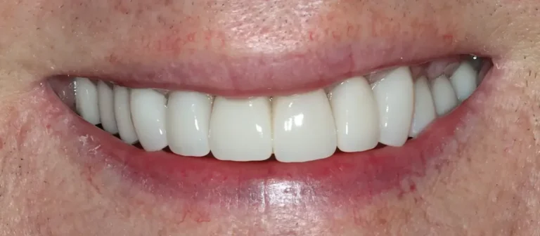 After cosmetic dentistry at Roots Dental in Bellingham showing bright, even teeth.