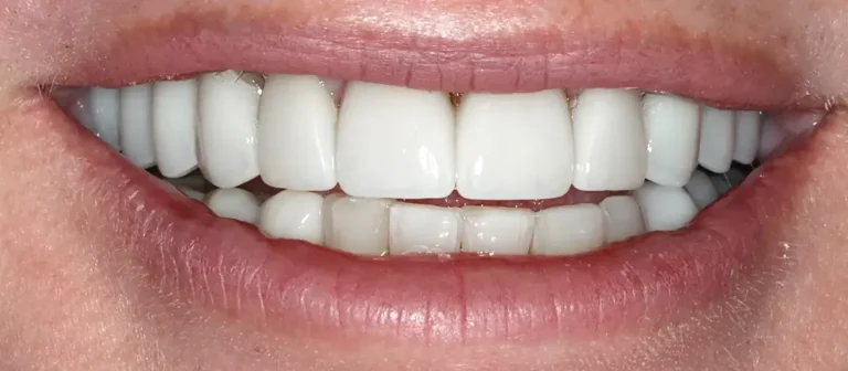 After full smile restoration with natural-looking dental crowns at Roots Dental in Bellingham.