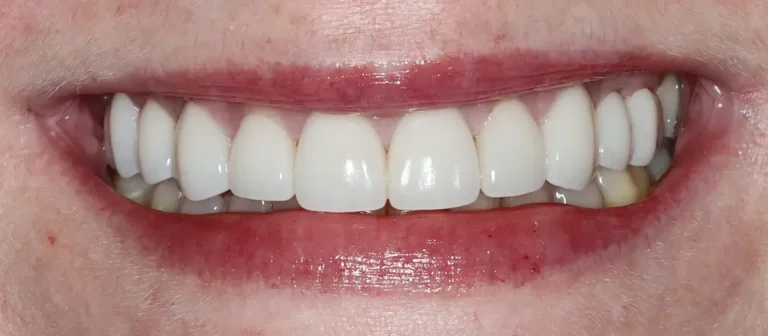 After cosmetic dentistry at Roots Dental in Bellingham showing bright, even, natural-looking teeth.