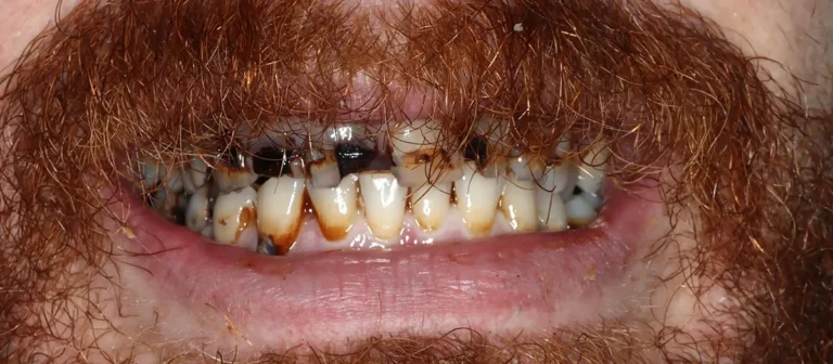 Close-up of severely decayed and stained teeth before treatment at Roots Dental, emergency dentist in Bellingham.
