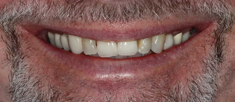 Close-up of damaged, stained, and decayed teeth before cosmetic dental treatment at Roots Dental in Bellingham.