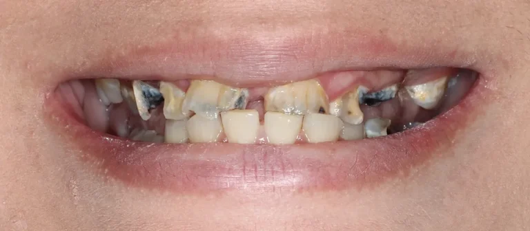 Close-up of severely decayed and broken teeth before restorative dental treatment at Roots Dental in Bellingham.