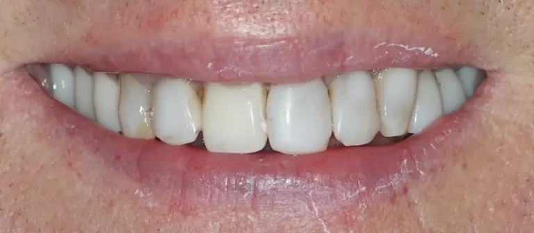 Before cosmetic dentistry at Roots Dental in Bellingham showing stained and uneven teeth.