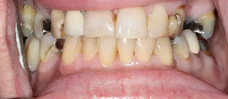 Before dental treatment showing damaged, discolored, and missing teeth at Roots Dental in Bellingham.