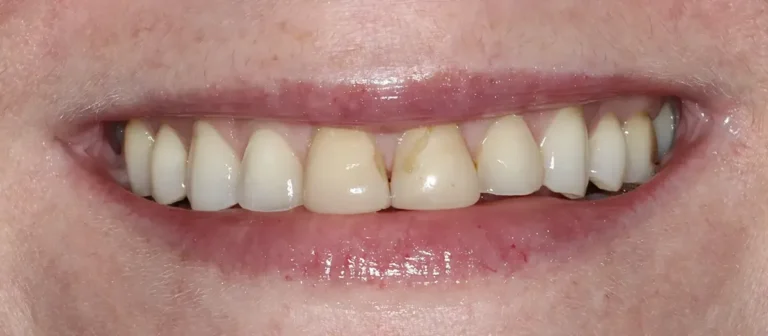 Before cosmetic dental treatment showing stained and uneven teeth at Roots Dental in Bellingham.