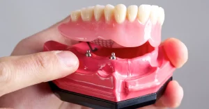 Full arch dental implants (All-on-X) model shown at Roots Dental in Bellingham.