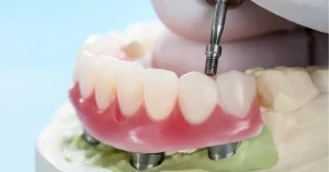 Close-up of full arch All-on-X dental implant bridge being secured at Roots Dental in Bellingham.