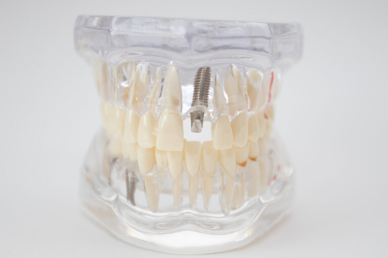 Dental model showing jaw with implant | dental implants cost